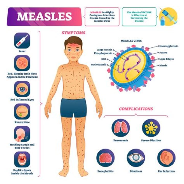 Understanding ER Zack Measles: A Comprehensive Guide